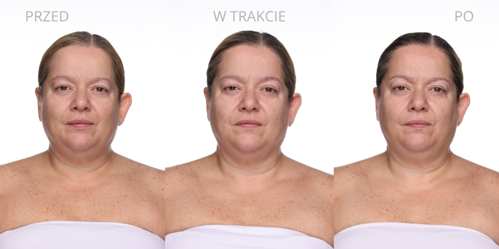 Therabody Neck & Chest LED - zdjęcia z badań klinicznych
